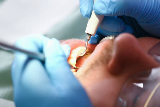 Best Knocked-Out Tooth (Avulsed Tooth) Treatment in Hartsville, TN